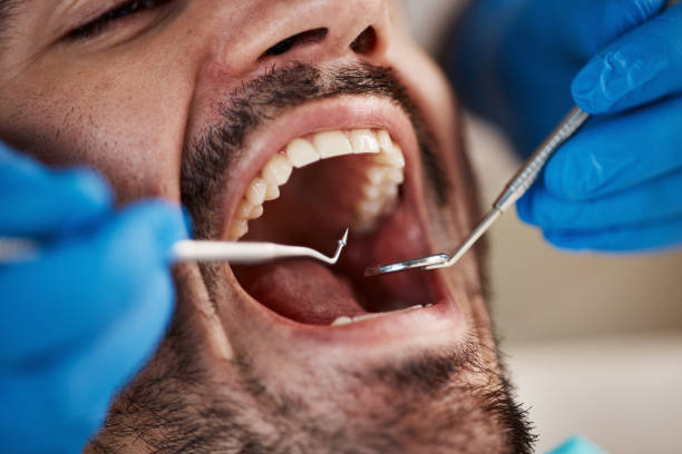 Best Knocked-Out Tooth (Avulsed Tooth) Treatment in Walnut Cove, NC